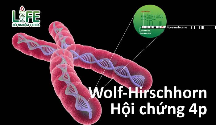 Nguyên nhân dẫn đến bệnh Wolf – Hirschhorn